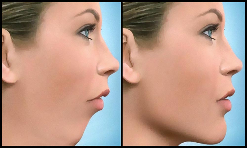 Orthognathic Surgery Risks Potential Complications and How to Minimize