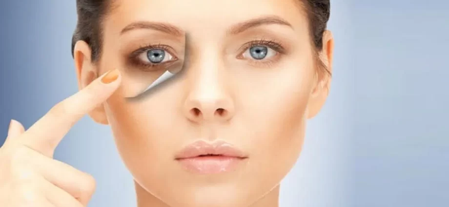 Dark Eye Circles Removal for Brighter Eyes